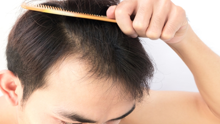 How Much Hair Loss is Normal?