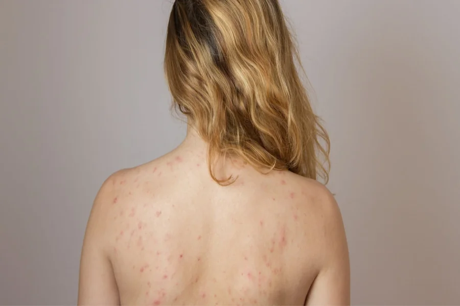 Salicylic